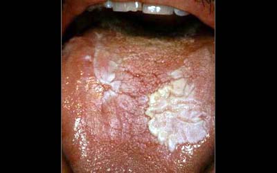 Leucoplasie de la face dorsale de la langue
