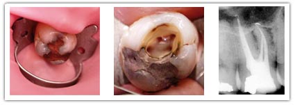 endodontie preventive