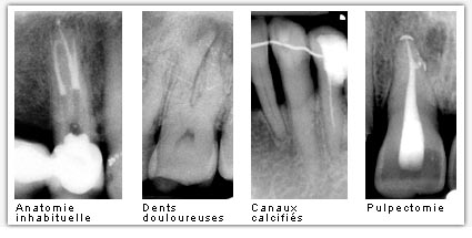 traitements endodontiques